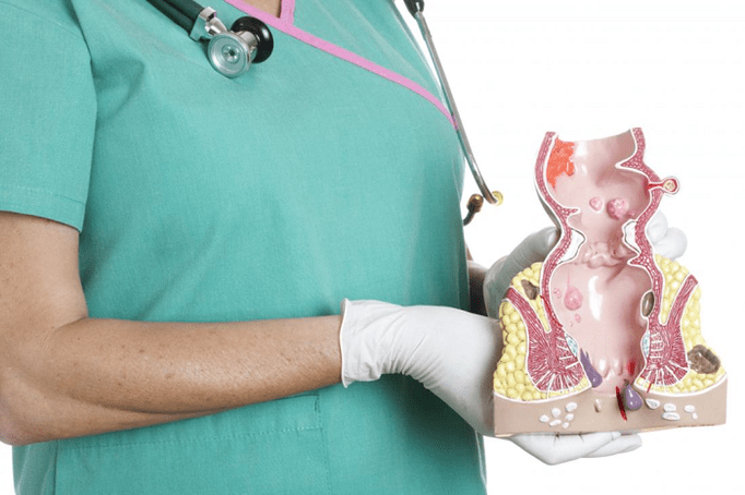 El médico demuestra el modelo de hemorroides