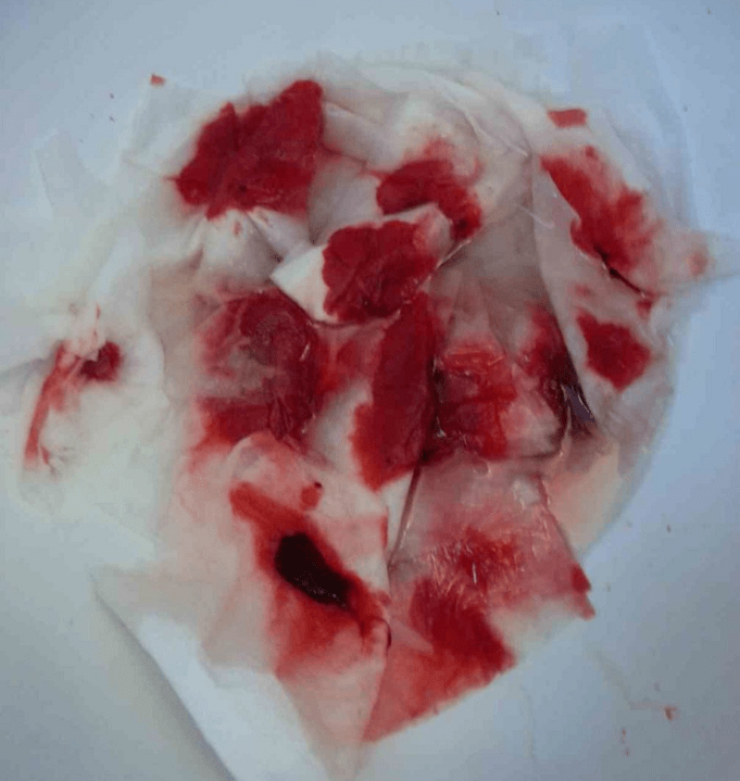 Sangrado con hemorroides