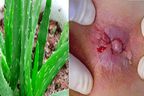 aloe para el tratamiento de hemorroides