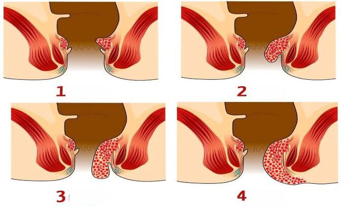 cómo se ven las hemorroides en diferentes etapas