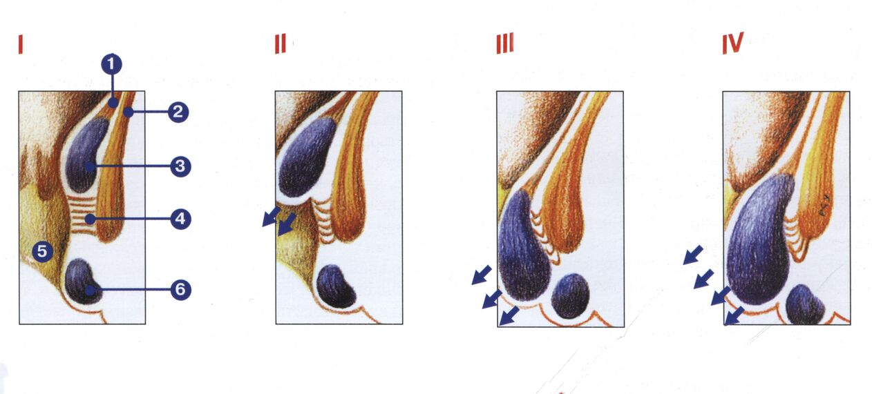 etapas del desarrollo de las hemorroides